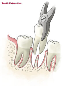 EVERYTHING YOU WANTED TO KNOW ABOUT THE FOLLOW UP AFTER TOOTH EXTRACTION