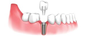 What Are Dental Implants?